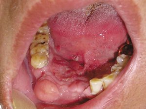 Что такое эритроплакия полости рта