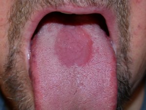 Симптомы эритроплакии рта