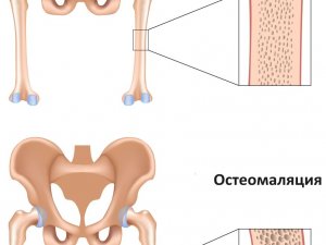 Симптомы остеомаляции