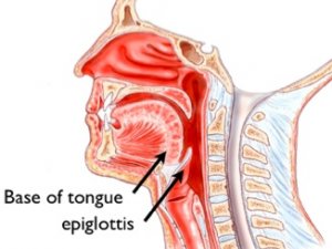 Что такое Эпиглоттит