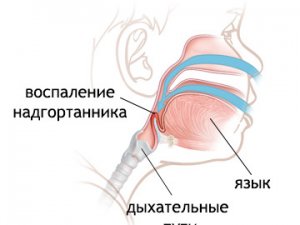 Причины эпиглоттита