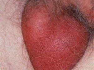 Симптомы орхоэпидидимита
