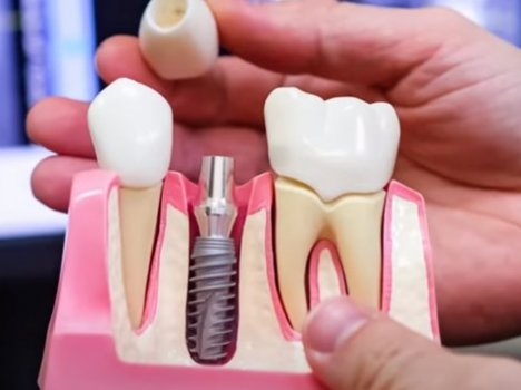 Имплантация зубов и ее этапы. Дентальные имплантаты. Протезная коронка