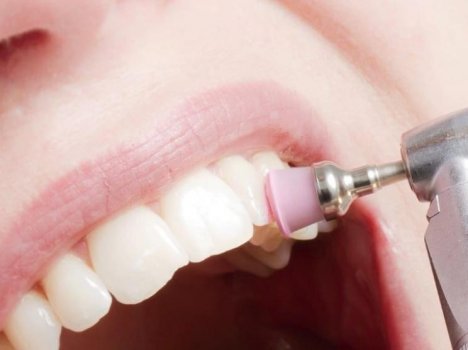 Безопасное отбеливание эмали в стоматологической клинике «Дентал Студио»