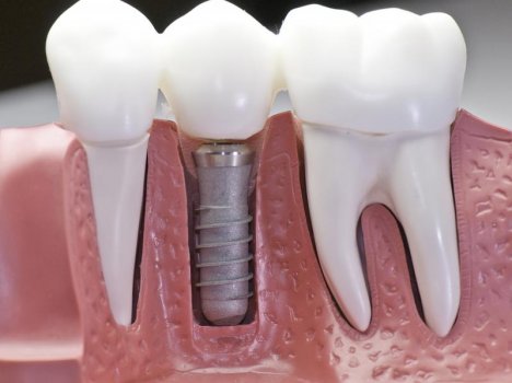 Виды зубных имплантатов