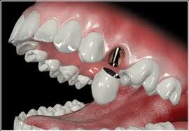 Абатмент — необходимая составляющая зубного имплантата