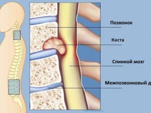 Что такое киста позвоночника?