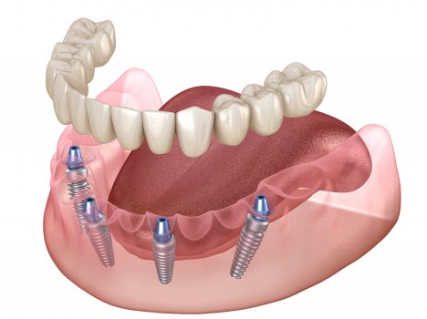Преимущества метода All-on-4 имплантация зубов