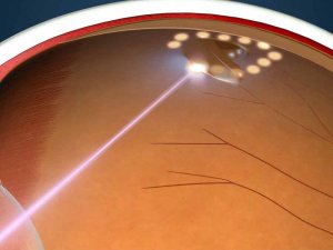 Причины отслойки сетчатки глаза и методы ее лечения