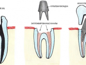 Наращивание зубов или коронка