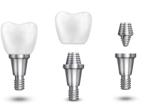 Имплантация зубов: инновационные технологии для красивой и здоровой улыбки